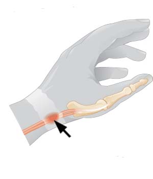 De quervain Tenosinovite schema